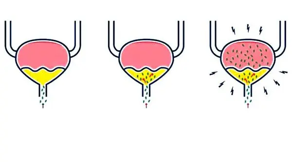 علائم عفونت ادراری