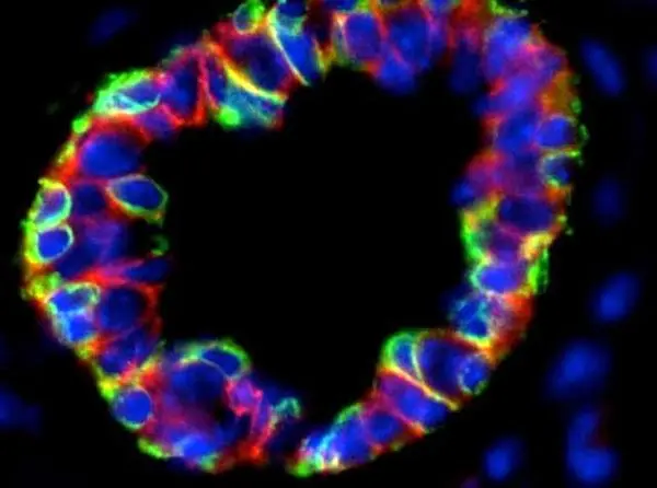 شناسایی یک عامل مهم در ابتلا به سرطان سینه