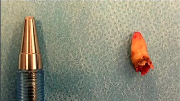 مردی که درون بینی اش دندان درآورد!+ عکس