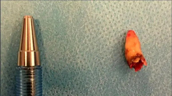 مردی که درون بینی اش دندان درآورد!+ عکس