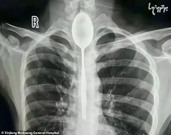 مردی که یک سال با قاشقی در گلویش زندگی کرد+عکس 
