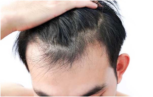 استرس، تغذیه و ریزش مو؛ ارتباط 3 گانه
