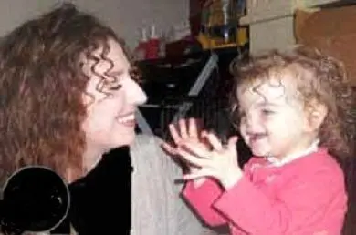 کودکی که بینی ندارد+عکس