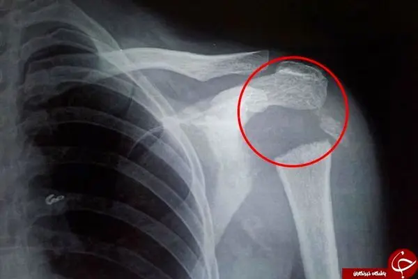 چرخش 180 درجه ای شانه یک جوان! +تصاویر