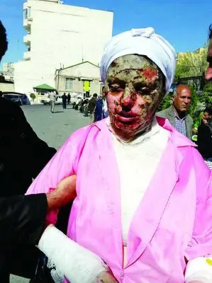 دختر زیبایی که قربانی اسید پاشی شد! +عکس