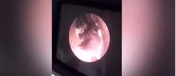 بیرون کشیدن سوسک زنده از گوش یک مرد + عکس