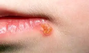 ترفندهایی خانگی برای درمان تبخال
