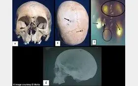 سرطان های متفاوت در میان مصریان باستان + عکس