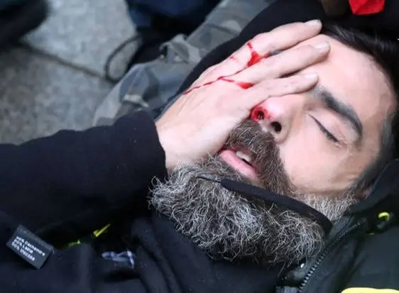 اصابت گلوله به چشم رهبر جلیقه زردها + عکس