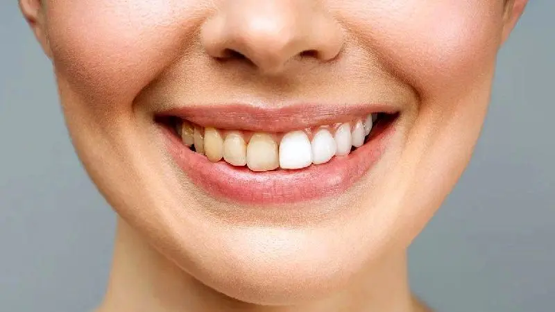 چگونه از تغییر رنگ کامپوزیت دندان جلوگیری کنیم؟