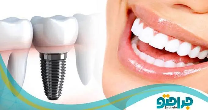 قیمت ایمپلنت دندان در سال1402چقدر است؟(مراحل ایمپلنت دندان)