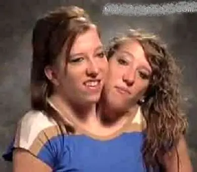 عجیب ترین دوقلوهای بهم چسبیده دختر در جهان+عکس