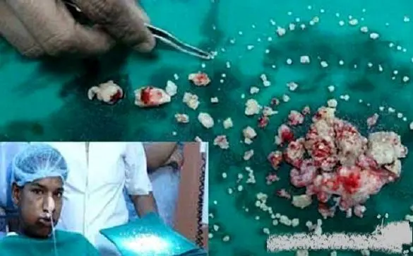 وجود 232 دندان در فک پایین یک نوجوان!+عکس