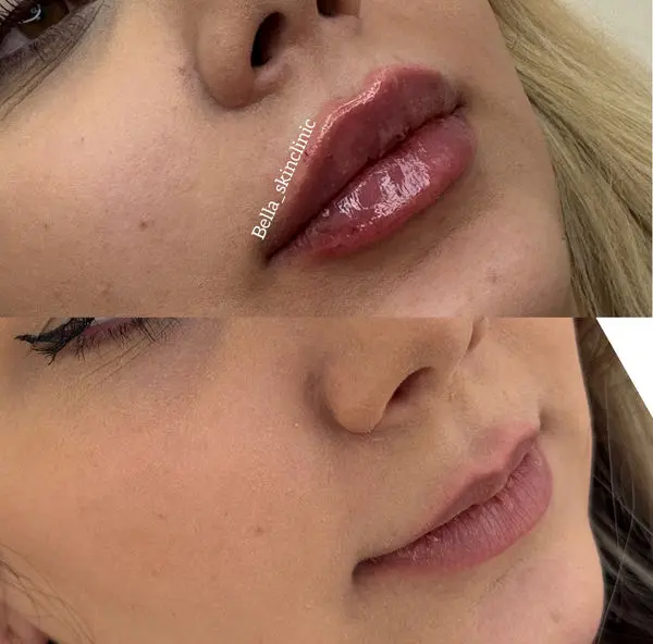 ژل لب روسی چیست و برای چه لب‌هایی مناسب است؟