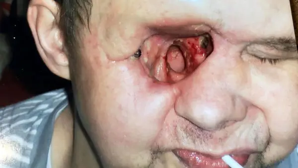 اشتباه پزشک، مردی را تبدیل به زامبی کرد! + عکس های تکاندهنده