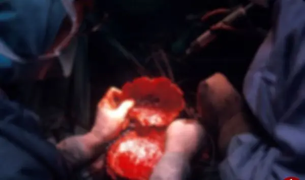 بیماری که به خاطر اشتباه پزشکی جمجهاش شکافته شد+عکس