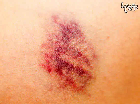 چرا بدن‌تان خود به خود کبود می‌شود؟ 