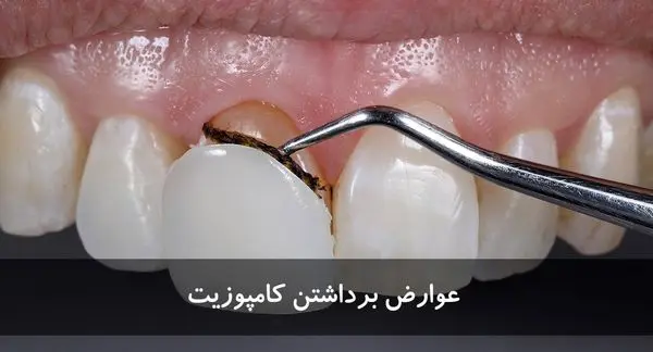 عوارض برداشتن کامپوزیت
