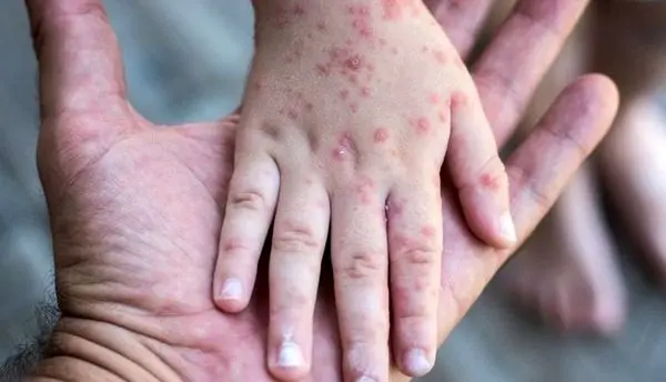 آمار جدید از مبتلایان سرخک در کشور