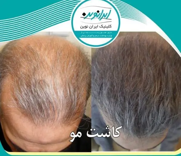 جشنواره 77 روزه کلینیک پوست و مو ایران نوین آغاز شد