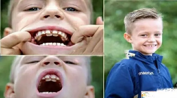 کودکی با ٣٠٠ دندان+عکس