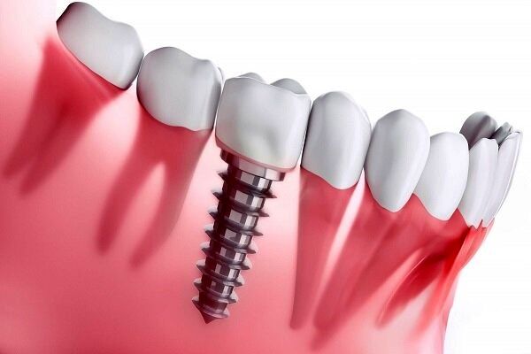 رازهای ناگفته افزایش طول عمر ایمپلنت