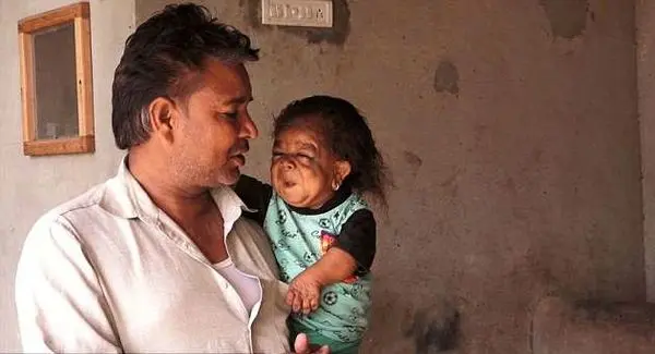 بیماری عجیب و غیرقابل باور یک جوان 23 ساله، او را شبیه کودک یک ساله کرده است +عکس