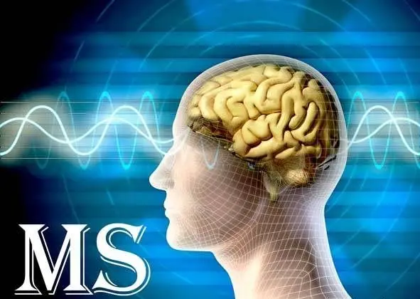 ۷۰ هزار ایرانی "ام اس" دارند