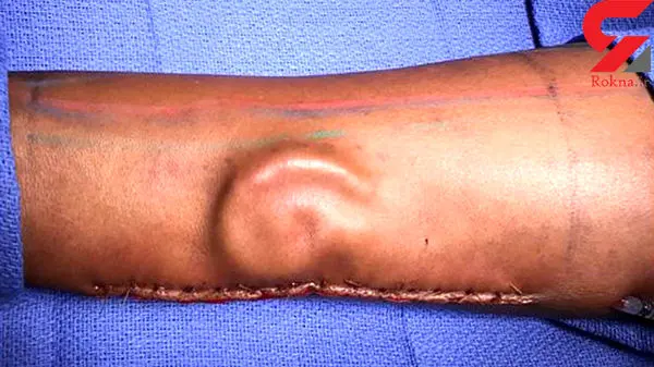 گوش قطع شده سرباز جوان به بازوی او پیوند زده شد! +عکس