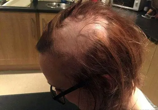 استرس امتحان این دختر را کچل کرد! +عکس