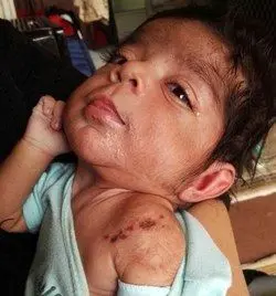 پرت کردن ته سیگار روشن نوزادی را سوزاند +عکس