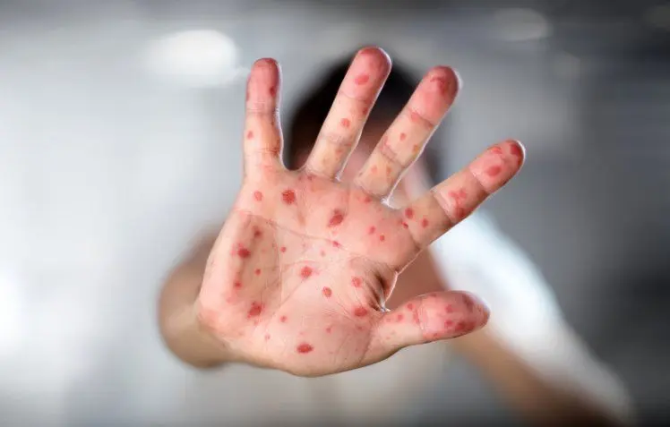 ۹۵ درصد ایرانیان واکسن سرخک زده اند