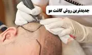 معرفی جدیدترین روش های کاشت مو در ایران