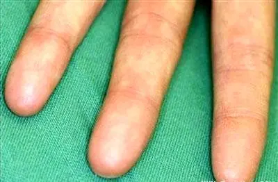 زن بسیار عجیبی که هیچ اثر انگشتی ندارد! +عکس