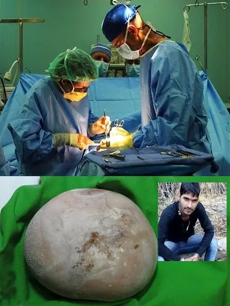 بزرگترین سنگ کلیه با اندازه ای عجیب و باورنکردنی! + عکس
