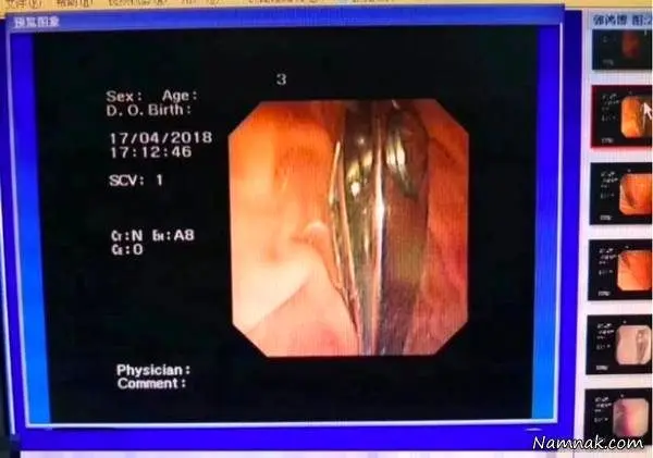 یک کودک از لج مادرش ناخن گیر قورت داد + عکس