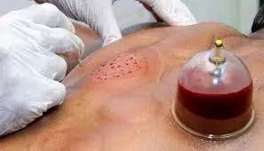 حجامت را در فصل بهار جدی بگیرید!
