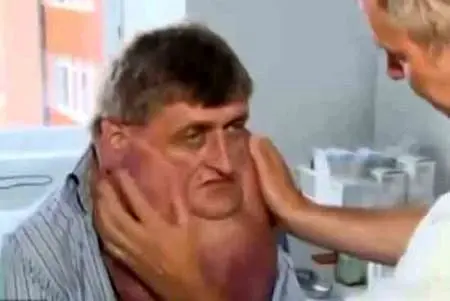 مردی عجیب با تومور 6 کیلویی روی صورتش+عکس