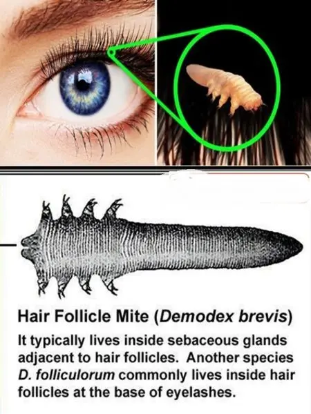 کِرم های زنده روی مژه+عکس