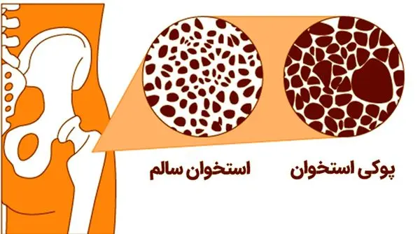 دریافت مستمر کلسیم و ویتامین دی؛ را فراموش نکنید!