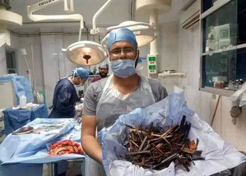 کشف صدها میخ و سکه از معده یک زن +عکس