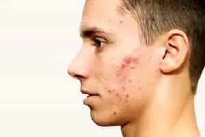 ناگفته هایی مهم درباره جوش صورت!