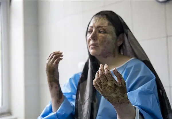 دختر تبریزی که به طرز وحشتناکی در اسید سوخت+عکس
