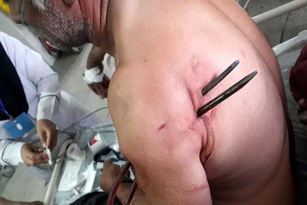 چنگک کشاورزی از بدن پیرمرد بیرون آورده شد +عکس