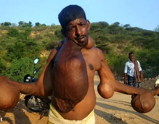 تومور‌های ۱۸ کیلویی عجیب و غریب یک مرد! + عکس