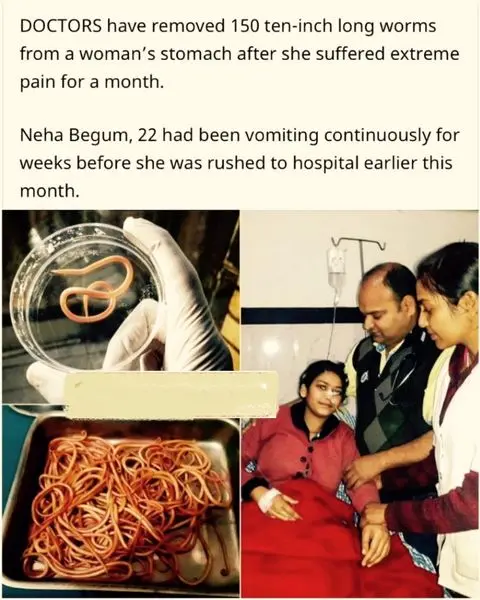 خارج کردن 120 کرم 25 سانتی از معده بیمار+عکس