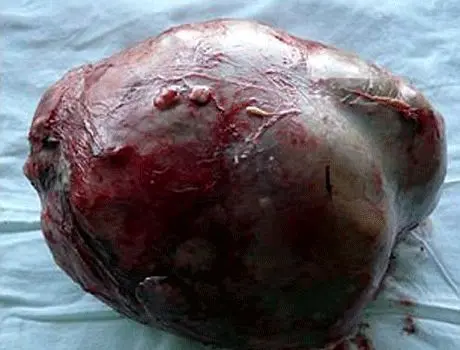 خروج توموری به اندازه توپ بسکتبال از شکم یک مرد! +عکس