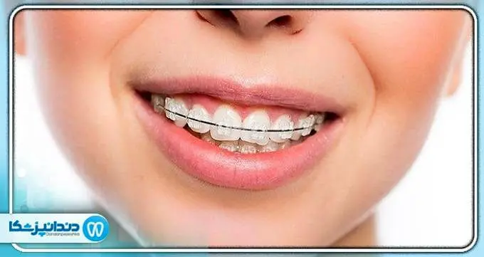 آیا می توان فقط دندان های یک فک را ارتودنسی کرد؟